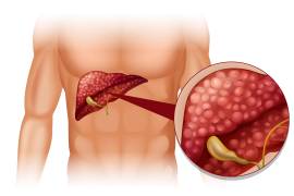 El hígado graso se ha convertido en una de las alertas de salud más frecuentes de los últimos años.