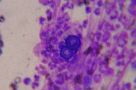 El hongo Blastomyces dermatitidis es el causante de una infección llamada blastomicosis.