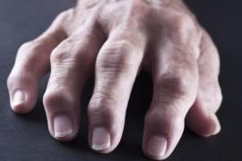 Bicarbonato de sodio reduce inflamación de la artritis