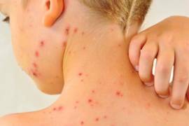 La mayoría de los contagios confirmados a nivel nacional se concentran en población infantil.