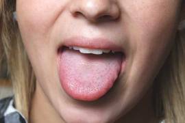 Lesiones en lengua y ardor en manos y pies, nuevos síntomas del coronavirus