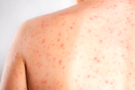 Autoridades sanitarias activaron monitoreo y cerco epidemiológico tras el caso vinculado con Allende.