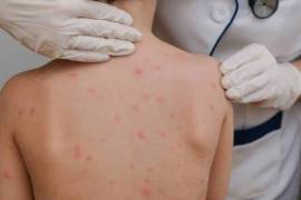 Un caso importado de sarampión cobró la vida de un menor en Durango, lo que llevó a las autoridades a reforzar el llamado urgente a la vacunación en personas de 6 meses a 49 años.