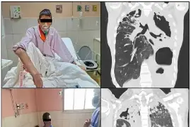 Dos baciloscopías realizadas a una persona fallecida resultaron negativas para tuberculosis, informó la autoridad sanitaria.
