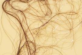 Los expertos no saben con exactitud cuán común es el efluvio telógeno.