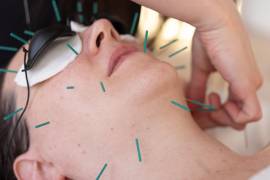 El interés por la acupuntura estética también se alinea con el naciente movimiento “notox”.