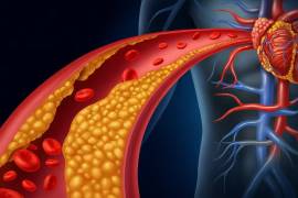 El colesterol y los triglicéridos elevados suelen avanzar sin síntomas, pero incrementan de forma significativa el riesgo de infarto y enfermedad cardiovascular.