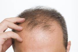 La mitad de los hombres pierden cabello por estrés y hormonas