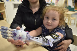 Una niña que nació sin antebrazo recibe una prótesis de &quot;Frozen&quot;