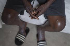 Un hombre no identificado infectado con mpox en el Hospital General de Goma, República Democrática del Congo.