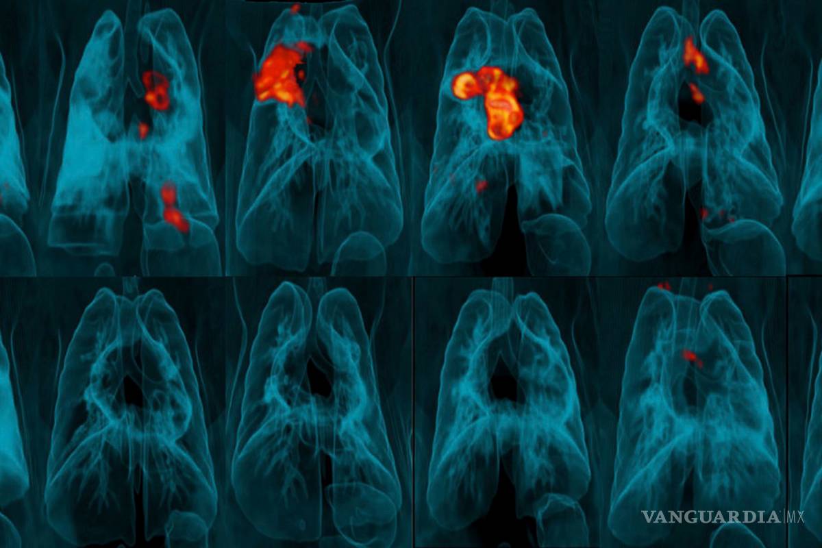 Vacuna contra tuberculosis da mejores resultados si es aplicada de forma intravenosa