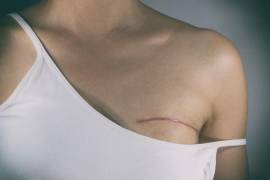 Las mujeres que sean sometidas a una mastectomía en alggún hospital de Coahuila, podrían recurrir a la prótesis mamaria de forma gratuita.