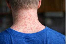 Con focos críticos en Jalisco, Ciudad de México y Chiapas, los especialistas advierten que la transmisión sigue activa y creciente, alcanzando picos de más de 600 casos semanales en marzo de 2026.