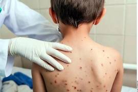 Fotografía en referencia a la enfermedad de sarampión.