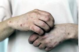 En la CDMX el brote de sarampión comenzó en agosto de 2025, cuando se confirmaron los primeros cinco contagios. Desde entonces y hasta la fecha, la Capital suma 158 contagios.