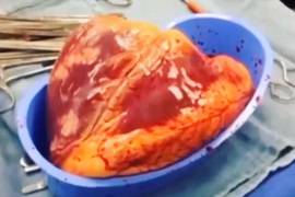 Corazón de cocainómano dejó de latir 25 minutos después de haber sido extirpado