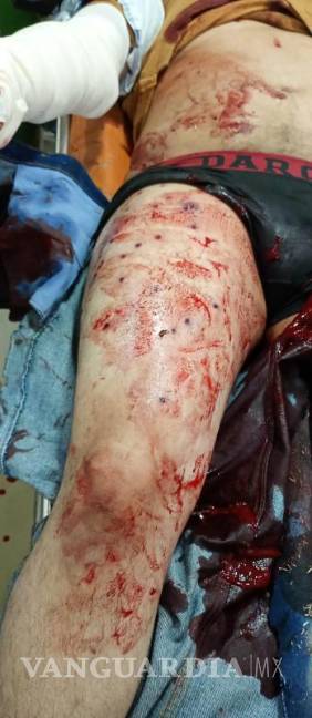 $!Juan Daniel Reyes Medrano resultó con once heridas de bala en la pierna derecha.