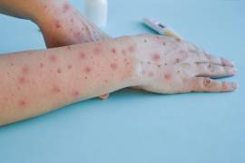 Efectos en la piel de la viruela del mono, ahora conocida como mpox.