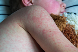 Menores de edad son el grupo más vulnerable al repunte del sarampión.