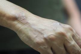 Señalan que el objetivo es evitar un repunte de lepra y cortar cadenas de transmisión.