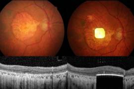 Un dispositivo eléctrico implantado debajo de la retina ayuda a restaurar parte de la agudeza visual a las personas con degeneración macular relacionada con la edad.