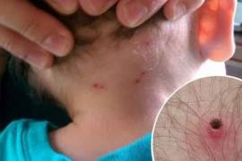 La rickettsiosis puede ser mortal cuando el diagnóstico y tratamiento se retrasan.