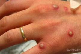 La OPS indicó que se han reportado más de mil 300 casos de viruela símica en las Américas desde el 10 de mayo en 14 países y territorios.