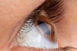 El queratocono afecta a un 2% de adolescentes, pero la falta de diagnóstico temprano puede llevar a complicaciones visuales graves, advierte experto en optometría.