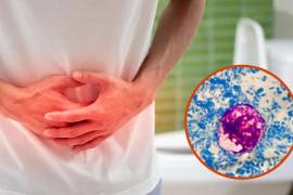 La ciclosporiasis es una infección intestinal causada por un parásito que se transmite principalmente a través de agua y alimentos contaminados.