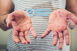 Ante el alza de casos de sarampión, la Organización Panamericana de la Salud (OPS) emitió una nueva alerta epidemiológica en todo América.