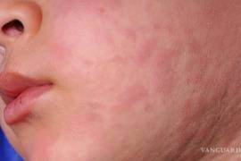 La Secretaría de Salud de México, como parte de su informe diario al corte del 16 de febrero, informó que el brote de sarampión en México suma 31 defunciones.