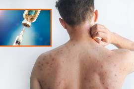 Sube la cantidad de fallecimientos por sarampión en México