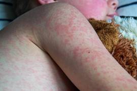 El brote de sarampión en México, al corte del 17 de febrero, superó los 10 mil 085 casos confirmados, con el acumulado de 6 mil 442 contagios en 2025 y otros 3 mil 643 en apenas mes y medio de 2026.