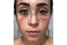 Denuncia que fue golpeada por su ex, hermano de candidata a diputada en Puebla