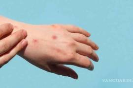 Los casos de viruela símica se han reducido en un noventa por ciento en el mundo en los tres últimos meses en relación con el trimestre anterior.