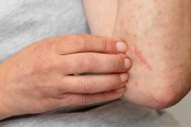 Los casos sospechosos aumentaron a 148 en la entidad, informó la Secretaría de Salud.