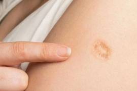 Claudia Sheinbaum aclara que la cicatriz en el hombro no es por la vacuna del sarampión, sino para otros padecimientos