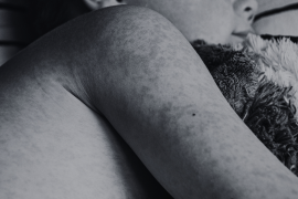 Primer fallecimiento por sarampión del 2026 en México