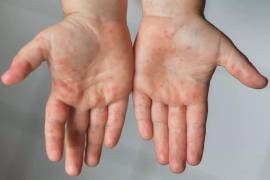 Catorce menores en Piedras Negras, Coahuila, fueron diagnosticados con el síndrome mano-pie-boca, infección viral contagiosa que afecta principalmente a niños.