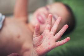 En entidades como Guerrero y Jalisco persisten focos activos, por lo que seguirán operativos de vacunación y vigilancia epidemiológica intensificada.