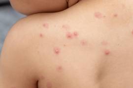 Con el balance nacional aún acotado y concentrado en pocas entidades, el seguimiento sanitario se mantiene activo.