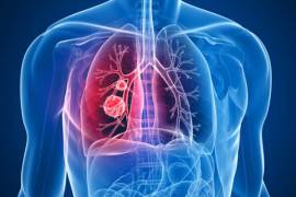 Más de 300 científicos pertenecientes al proyecto británico TRACERx lograron crear el mapa más exhaustivo sobre la evolución genómica del cáncer de pulmón.