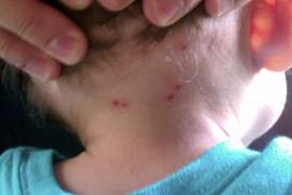 En Coahuila han fallecido siete personas a causa de la rickettsia, cinco eran menores de edad.