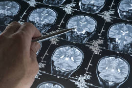 Alzheimer podría ser curado, científicos chilenos descubren cómo detener su progreso
