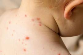 México supera los 9 mil casos de sarampión en 2025, con un incremento notable en varias entidades. La Secretaría de Salud reporta 28 defunciones y refuerza estrategias de prevención ante la expansión del brote.