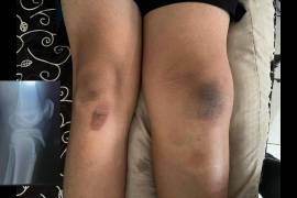 El alumno lesionado fue trasladado por sus padres tras el accidente durante la clase de educación física en el Instituto Bilingüe La Cañada.