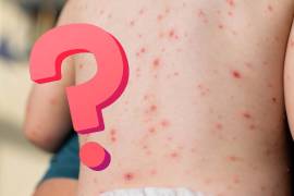 Conoce las diferencias entre sarampión y varicela, sus síntomas, contagio, riesgos y la importancia de la vacunación para prevenir brotes.