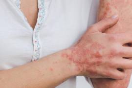 Las enfermedades autoinmunes pueden manifestarse con síntomas comunes que muchas personas ignoran. Reconocer las señales tempranas puede marcar la diferencia en el diagnóstico y tratamiento oportuno.