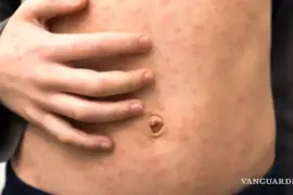 El estado coahuilense y Durango se volverían el tercer lugar de casos registrados de sarampión.