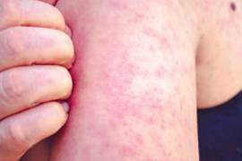 La detección del caso activó protocolos sanitarios en Acuña, aunque el contagio no se originó directamente en este municipio.